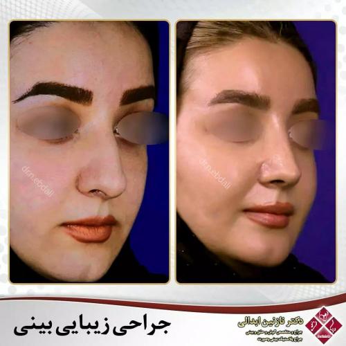 جراحی-بینی-475