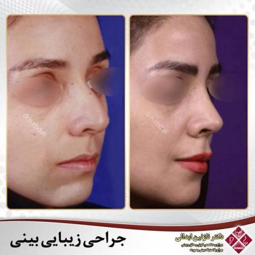 جراحی-بینی-476