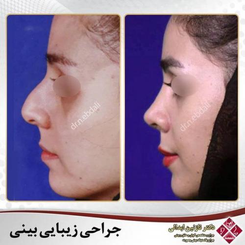 جراحی-بینی-477