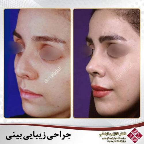 جراحی-بینی-478