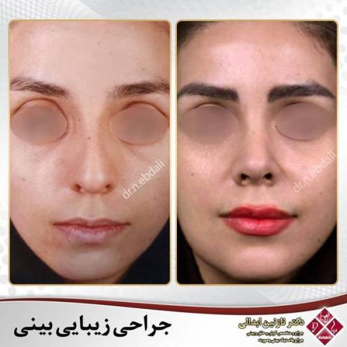 جراحی-بینی-479