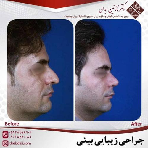 جراحی-بینی-480