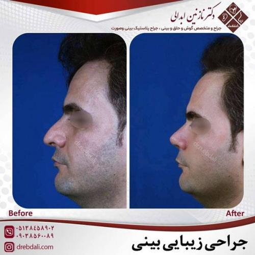 جراحی-بینی-481