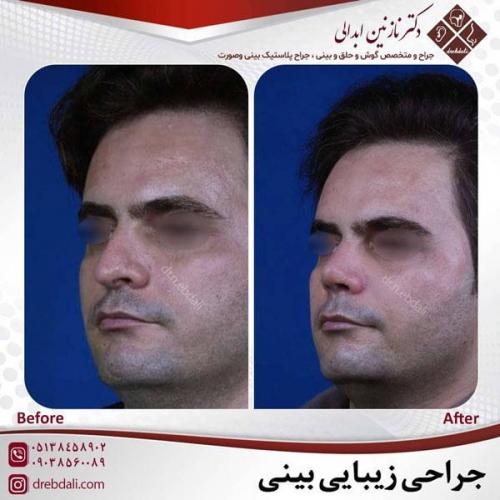 جراحی-بینی-482