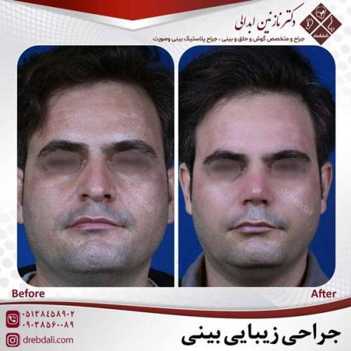 جراحی-بینی-483
