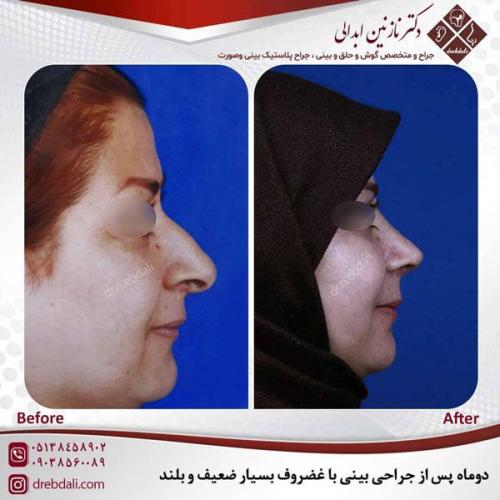 جراحی-بینی-484