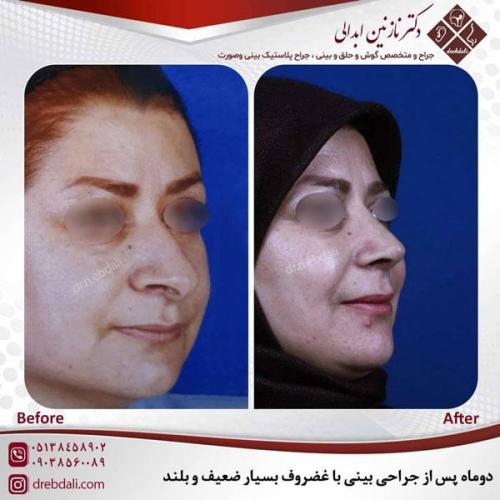 جراحی-بینی-485