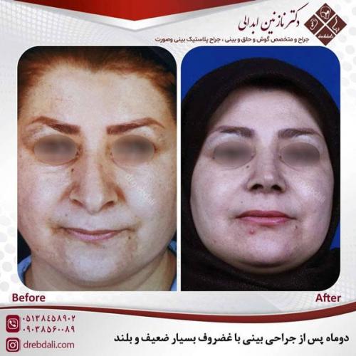 جراحی-بینی-486