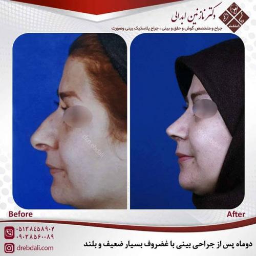 جراحی-بینی-487
