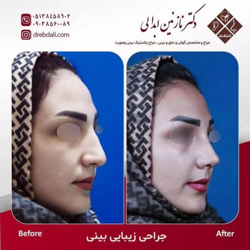 جراحی-بینی-489