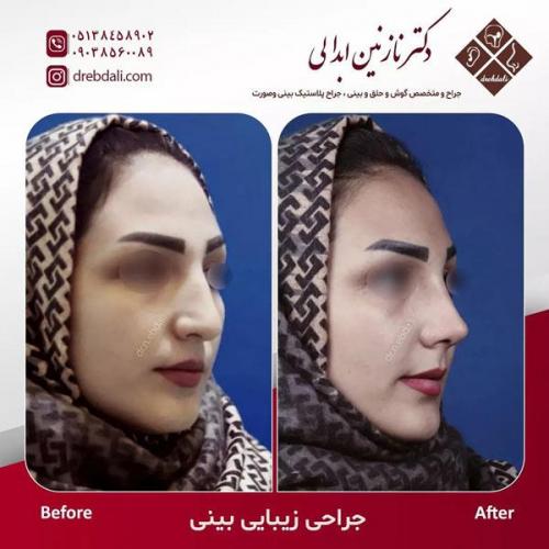 جراحی-بینی-490