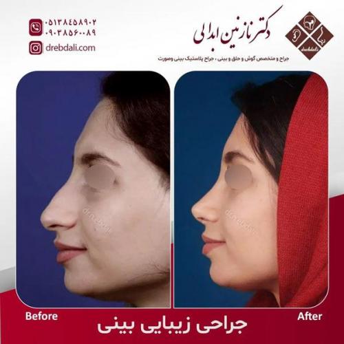 جراحی-بینی-500