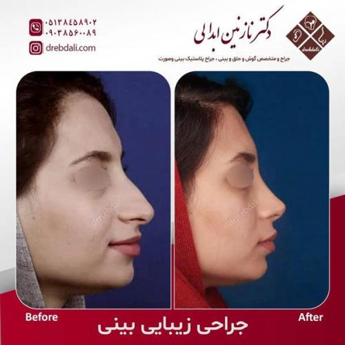 جراحی-بینی-501
