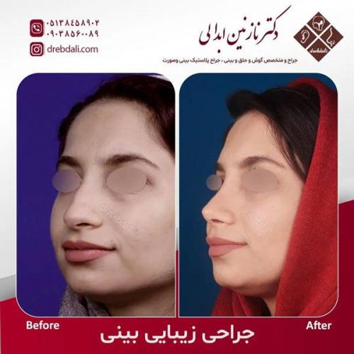 جراحی-بینی-502