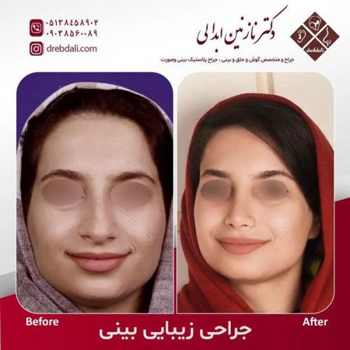 جراحی-بینی-503