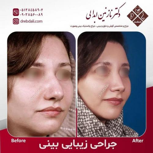 جراحی-بینی-507