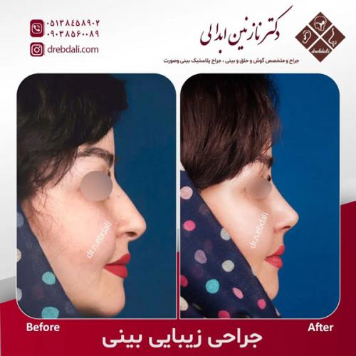 جراحی-بینی-561-Copy