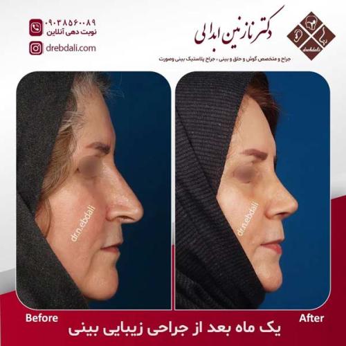 جراحی-بینی-600