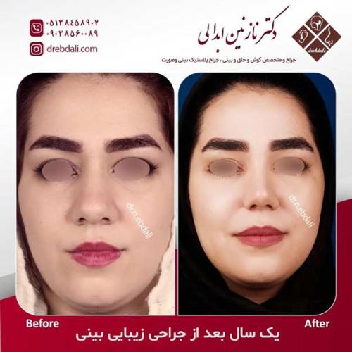 جراحی-بینی-601