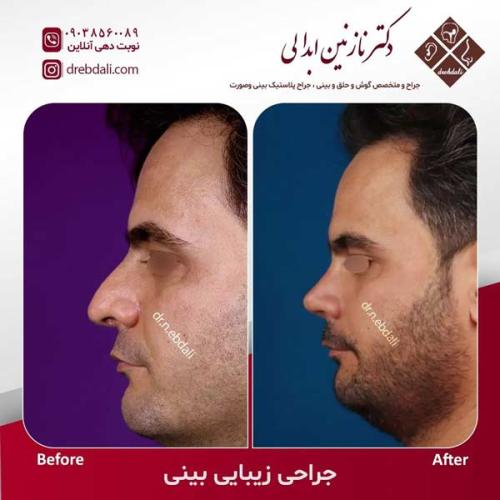 جراحی-بینی-602