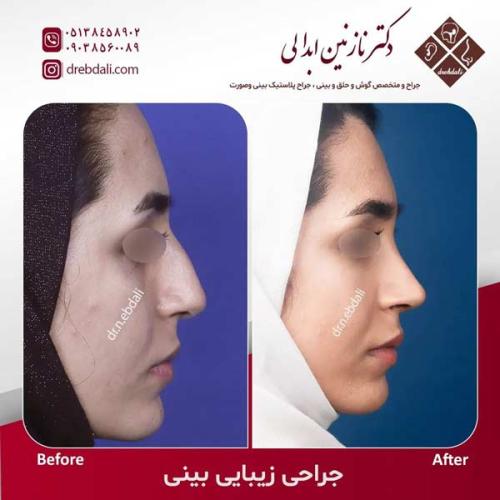 جراحی-بینی-603