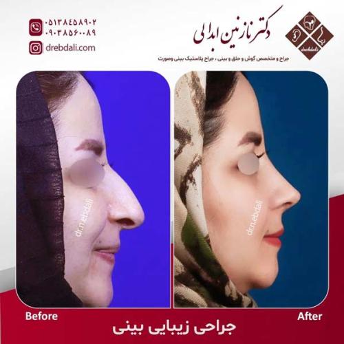 جراحی-بینی-609