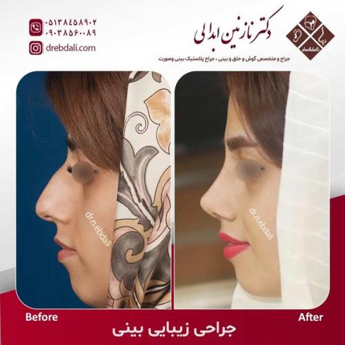جراحی-بینی-610