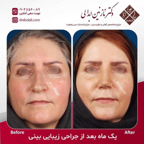 جراحی-بینی-611