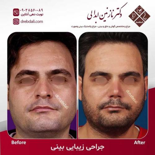 جراحی-بینی-612