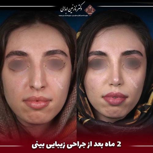 جراحی-بینی-654