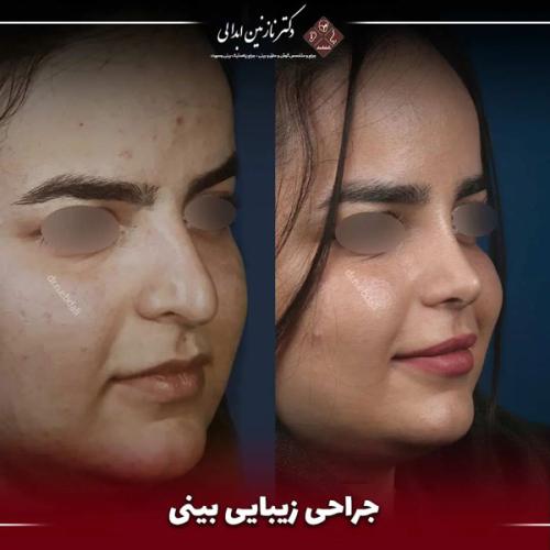 جراحی-بینی-655