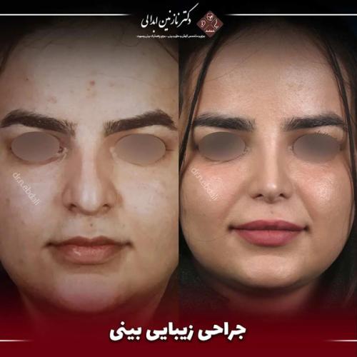 جراحی-بینی-656