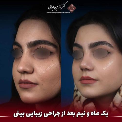 جراحی-بینی-657