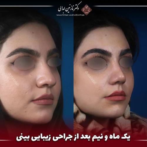 جراحی-بینی-658