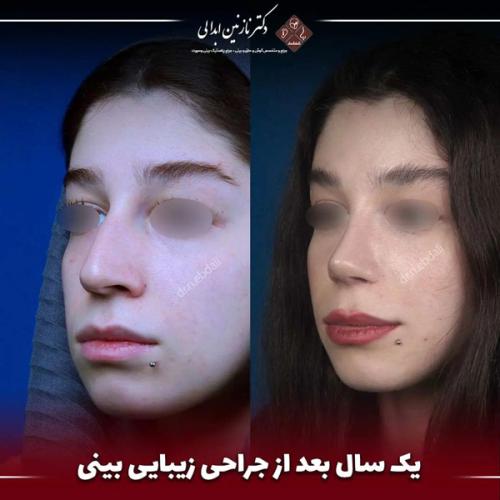 جراحی-بینی-659