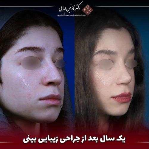 جراحی-بینی-660