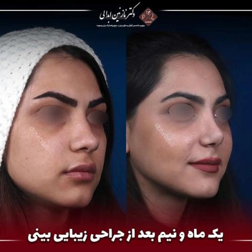 جراحی-بینی-661