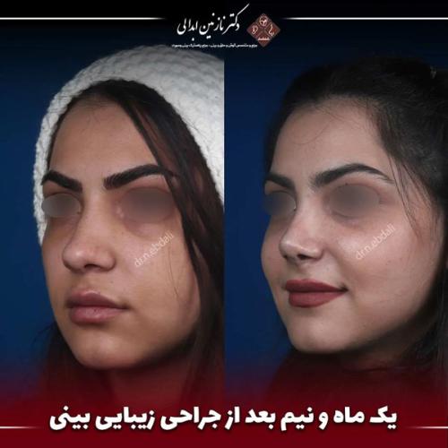 جراحی-بینی-662