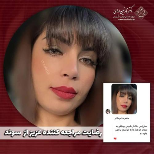 جراحی-بینی-663