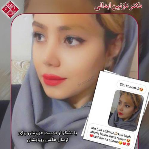 جراحی-بینی-مشهد-1