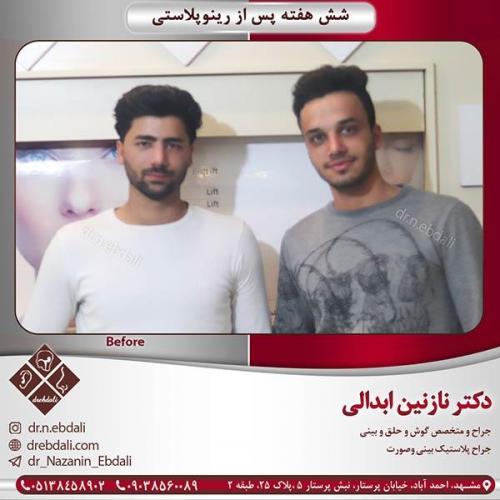 جراحی-بینی-مشهد-10