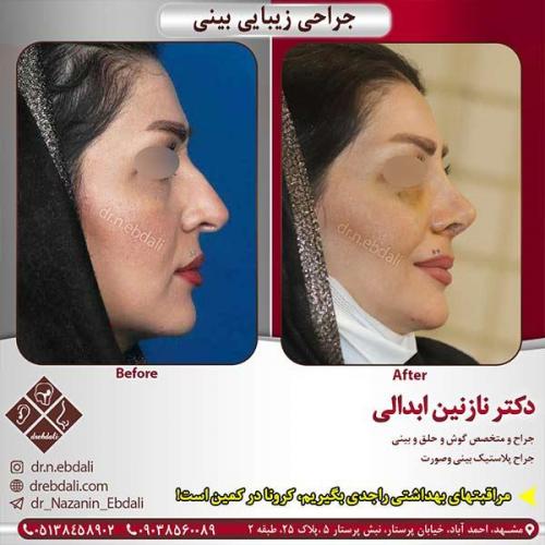 جراحی-بینی-مشهد-100