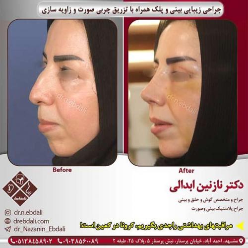 جراحی-بینی-مشهد-101