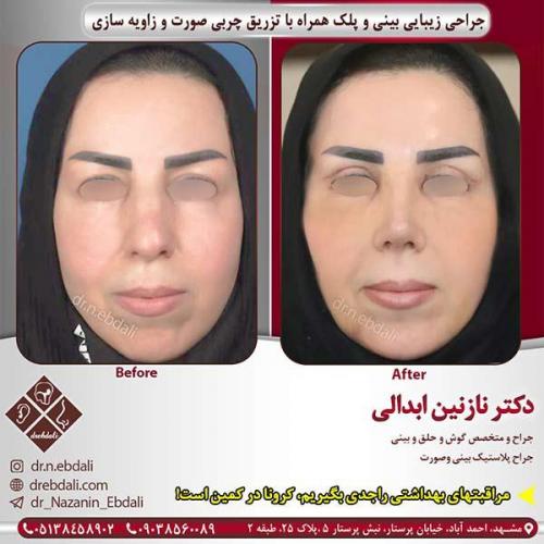 جراحی-بینی-مشهد-102