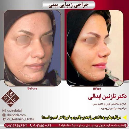 جراحی-بینی-مشهد-103