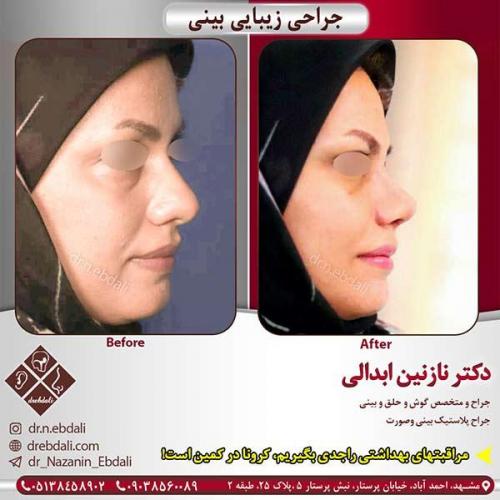 جراحی-بینی-مشهد-104