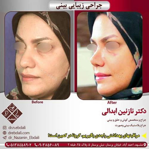 جراحی-بینی-مشهد-105