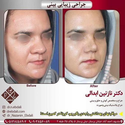 جراحی-بینی-مشهد-107