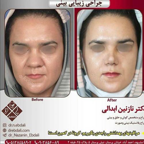 جراحی-بینی-مشهد-108