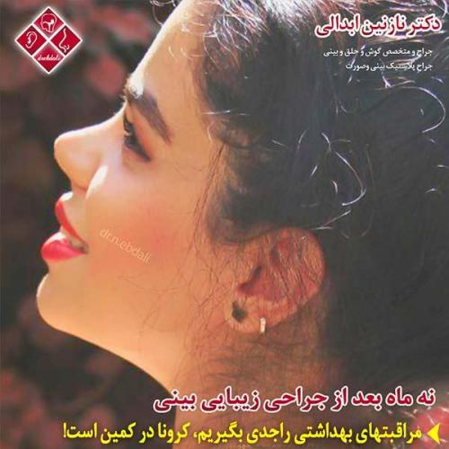 جراحی-بینی-مشهد-109